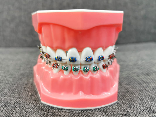 What Foods Are Off Limits During Braces Treatment?